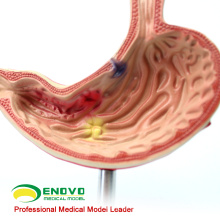 STOMACH01(12534) Half Size Human Diseased Stomach Medical Science Anatomical Stomach Model